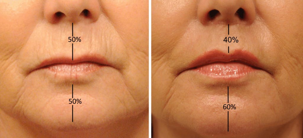 lip shortening blog