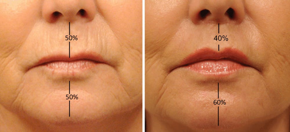 lip shortening blog