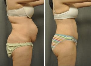 Abdominoplasty with Liposuction of the Back 21508 (2)