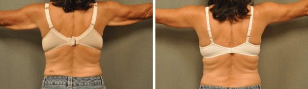 Arm Lift Brachioplasty San Diego Blog