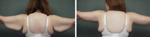 Arm Lift (Brachioplasty) blog