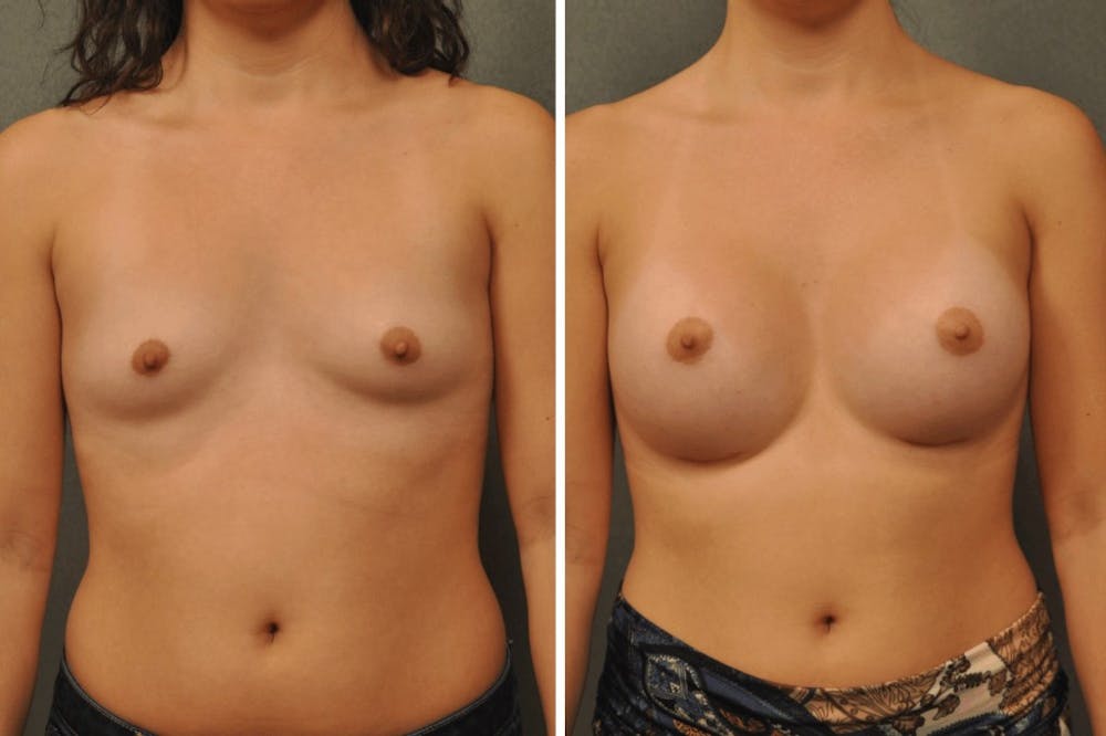 Breast Augmentation with Silicone Round Implants 21747