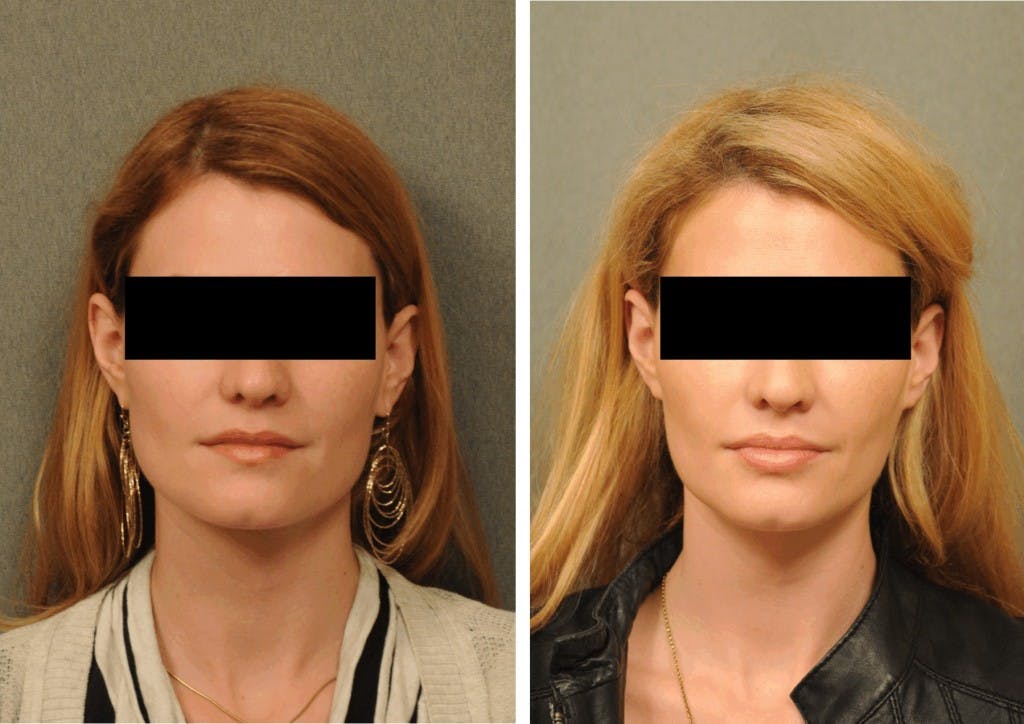 Jaw reduction  Dysport Changes Plastic Surgery