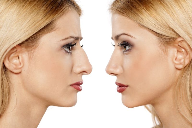 Before and after rhinoplasty