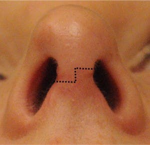 rhinoplasty open technique