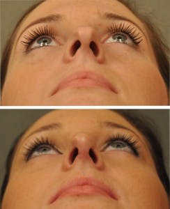 Worms Eye Open Rhinoplasty Witte