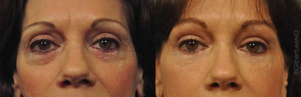 Before and after fat grafting