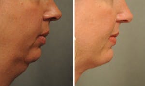 #Liposuction of the neck