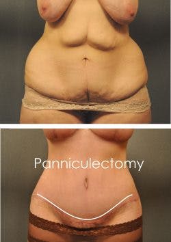 before and after panniculectomy