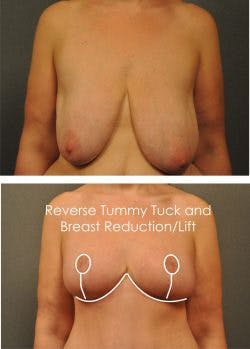 before and after reverse tummy tuck breast lift