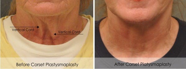 Corset Platysmaplasty Neck Lift San Diego