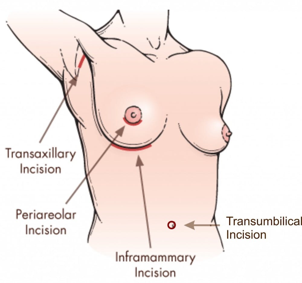 Implant entry incisions.