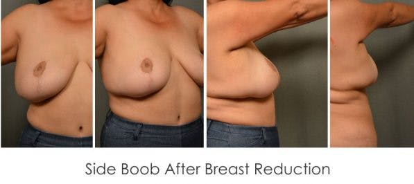 Before and after breast reduction