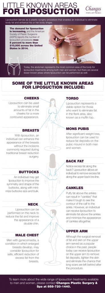 Liposuction Infographic