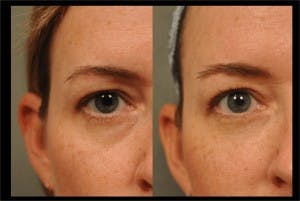 Restylane to Undereyes at Changes Plastic Surgery & Spa