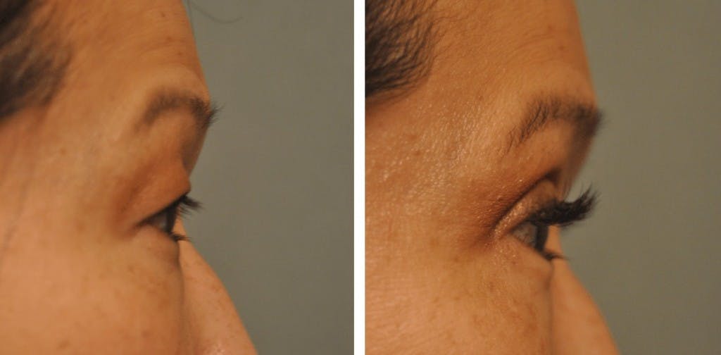 Asian Double Fold at Changes Plastic Surgery