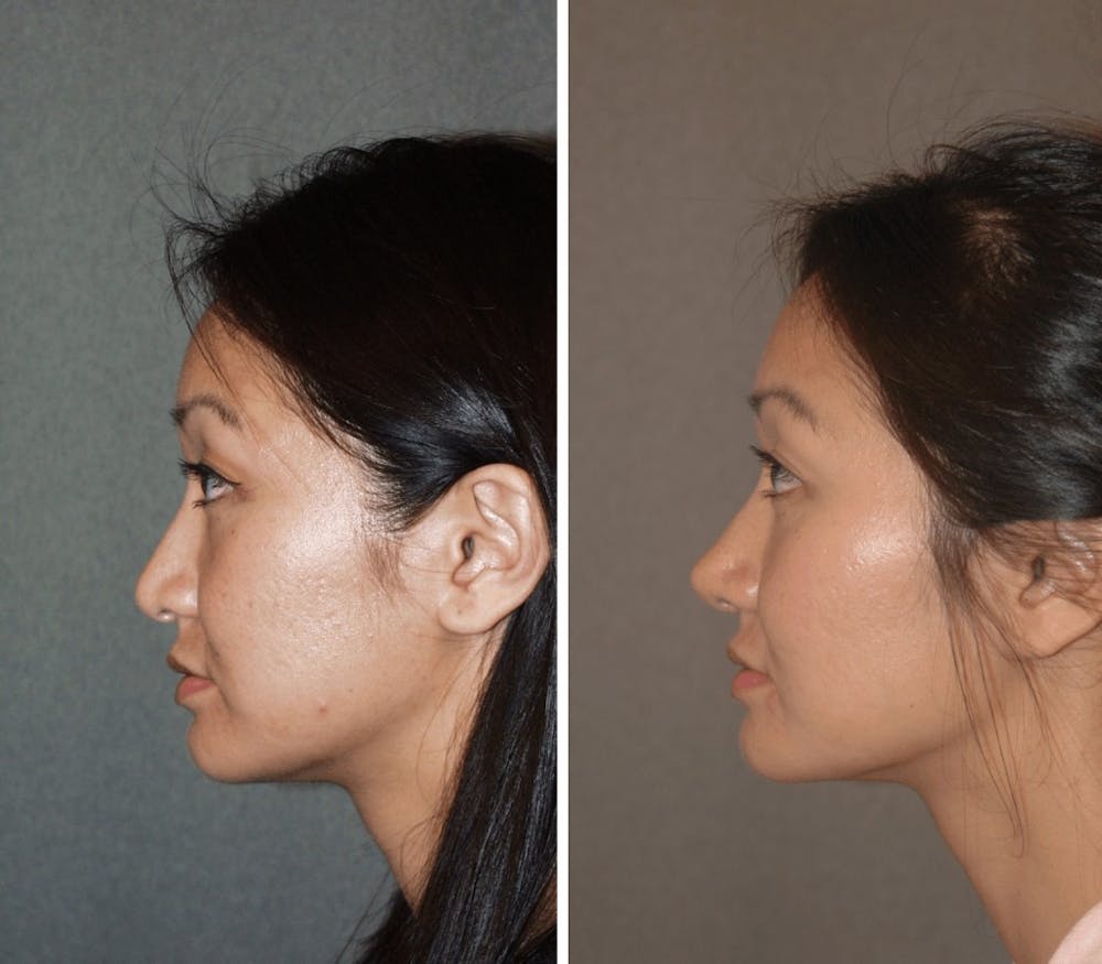Asian Rhinoplasty at Changes Plastic Surgery
