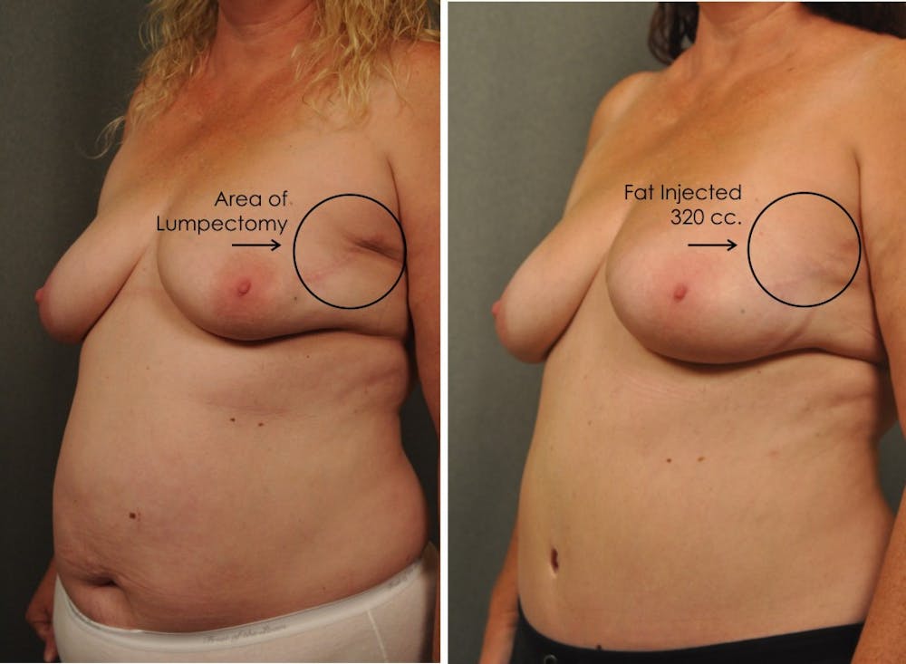Breast Reconstruction with Brava Expansion and Fat Grafting 2