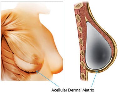 Acellular-Dermal-Matrix