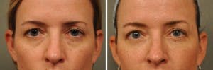 Restylane to Undereyes