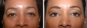 Fat Grafting to Undereyes 2