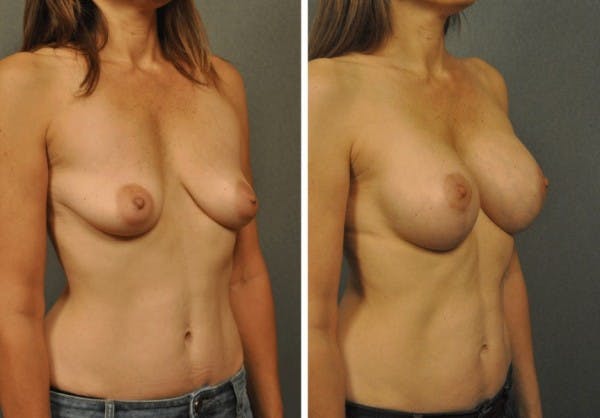 Breast Augmentation with Vertical Mastopexy 21213b