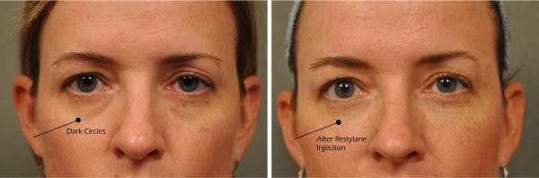 changes-plastic-surgery-under-eye-treatment