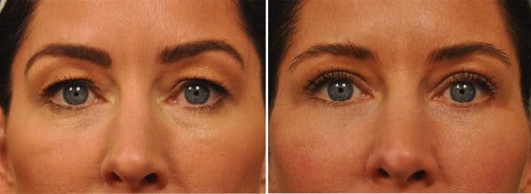 Upper and Lower Eyelid Surgery (Blepharoplasty)