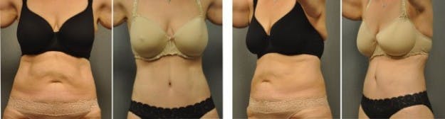 Blog Tummy Tuck Lipo Laser-2