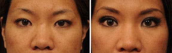 asian-double-fold-eyelid-14