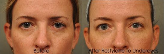 Restylane, dermal filler, undereye bags, 