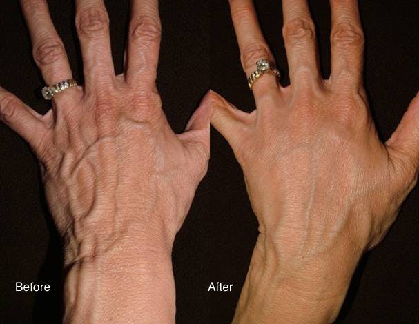 Radiesse handrejuvenation