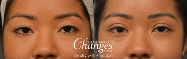 Asian Double Fold Eyelid Surgery