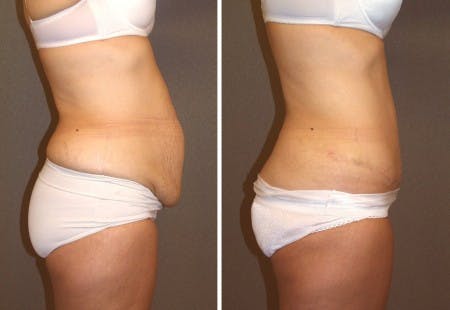 Tummy Tuck 4