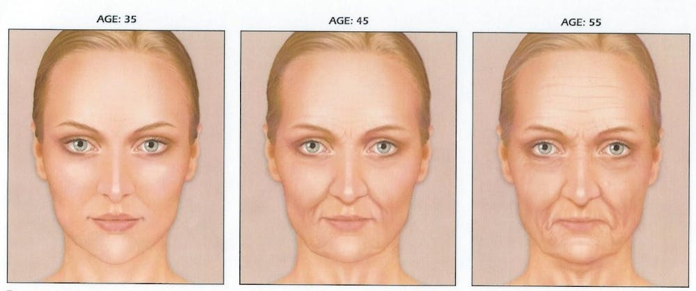 Skin Aging