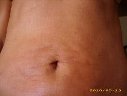 reverse tummy tuck in san diego