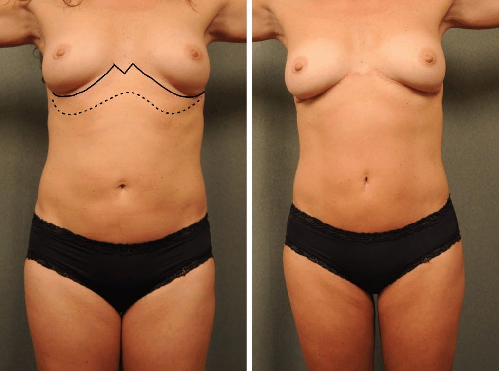 Reverse abdominoplasty specialists