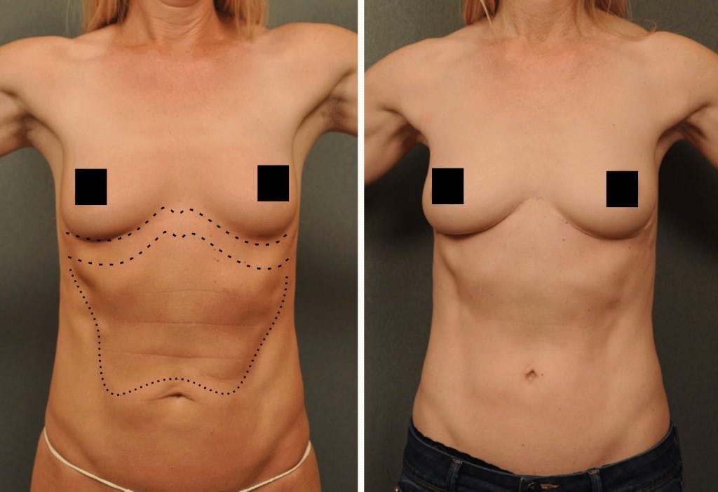 Reverse Tummy Tuck in San Diego