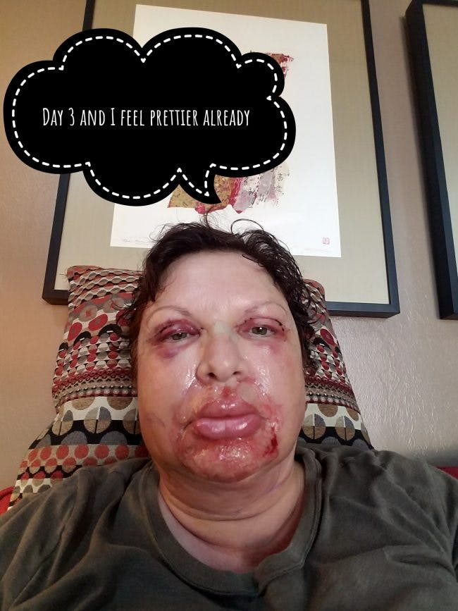 3 days after surgery