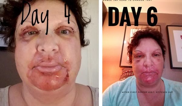 4-6 days after surgery