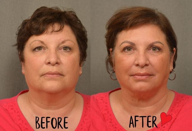 plastic surgery recovery journey