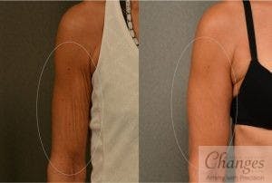 Before and after BodyTite