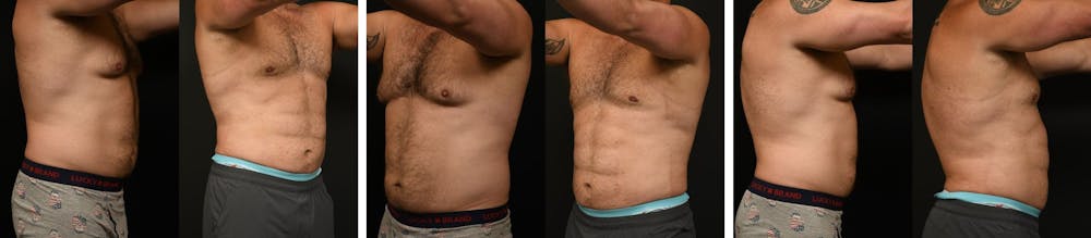 Before and after Liposuction