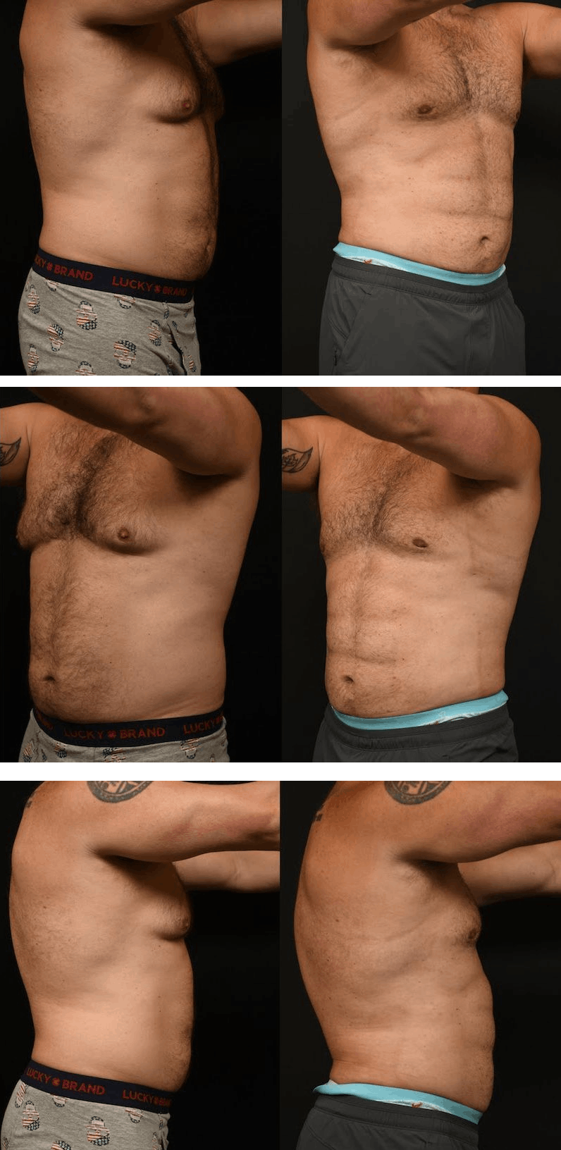 Before and after Liposuction