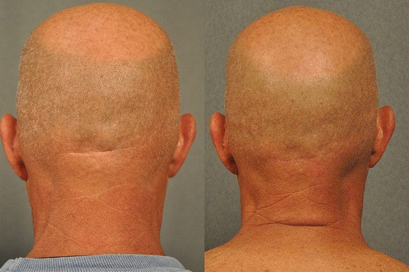 Before and after scar removal