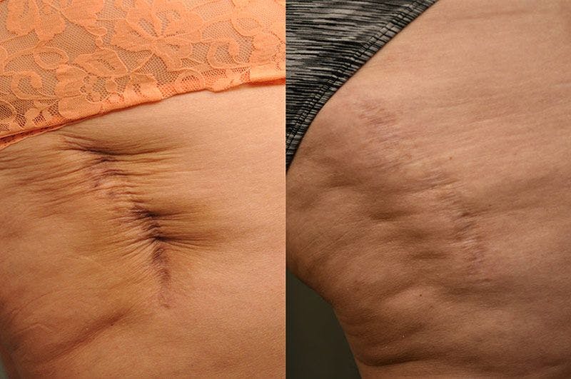 Before and after scar removal