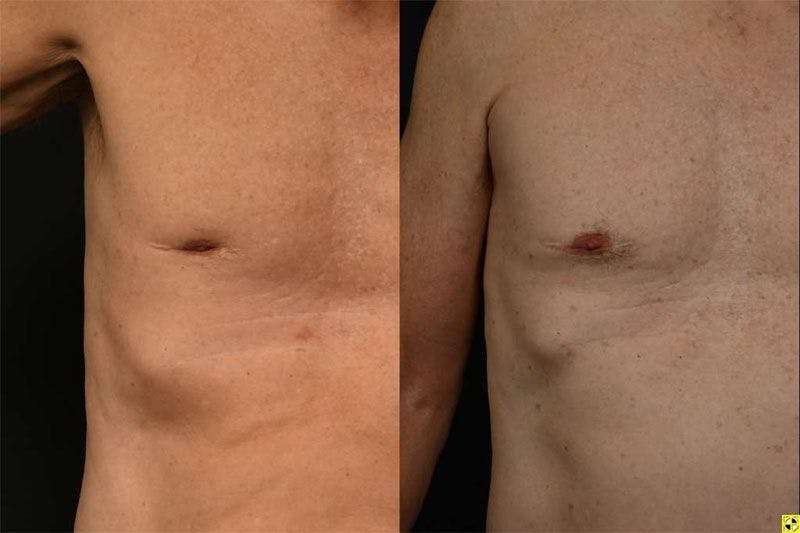 Before and after scar removal