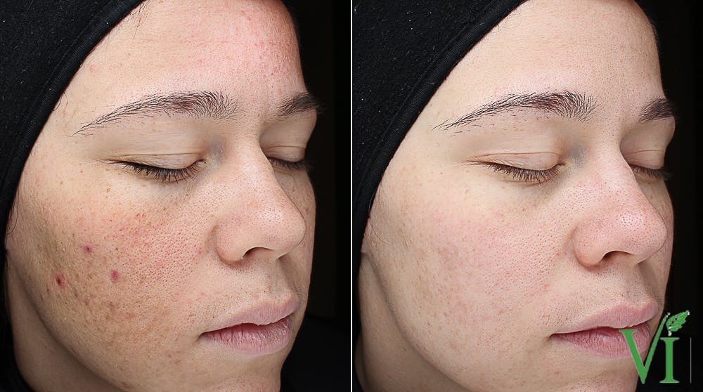 Before and after Chemical peels