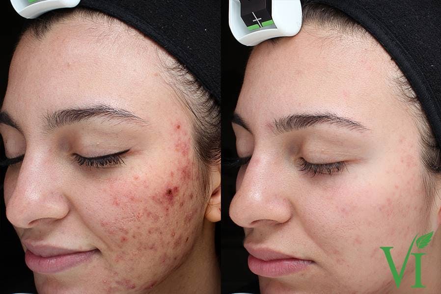 Before and after Chemical peels