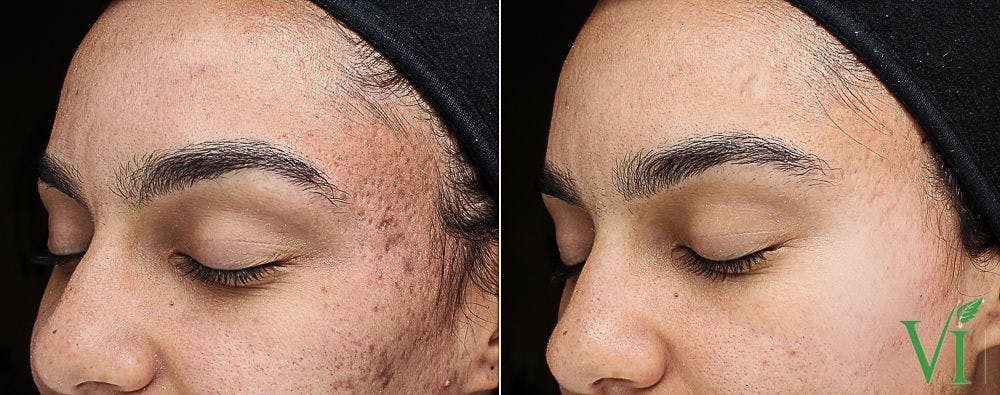 Before and after Chemical peels